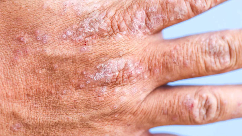 Atopic dermatitis