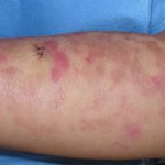 Erythrokeratodermia progressiva symmetrica ichthyosis Definition of
