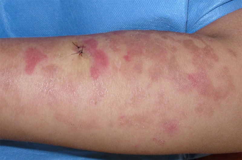 Ichthyosis erythrokeratodermia variabilis