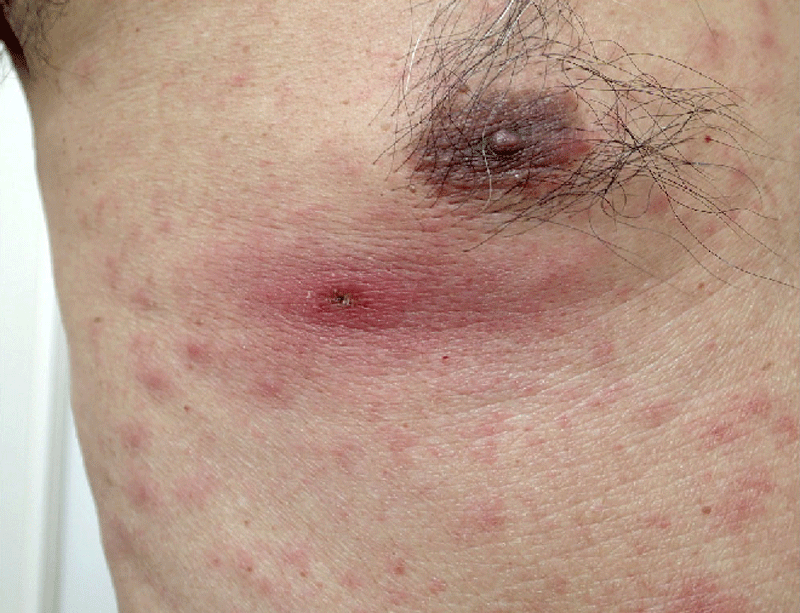 Scrub typhus Definition of Scrub typhus