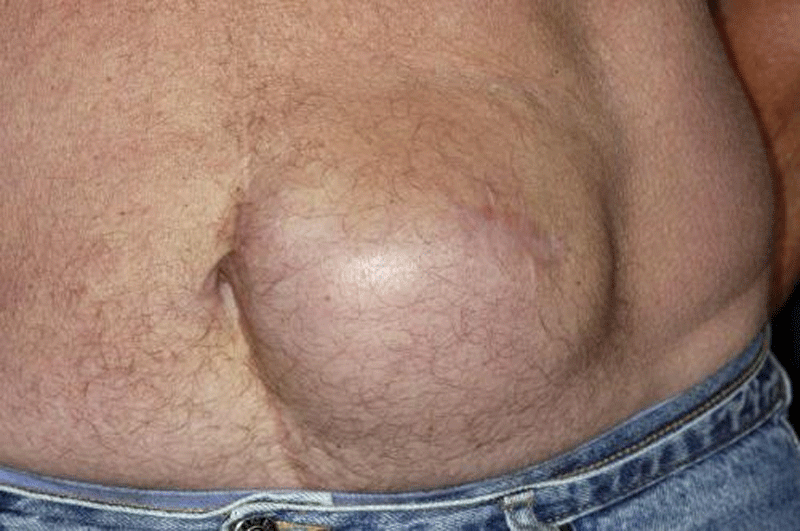 Abdominal hernia