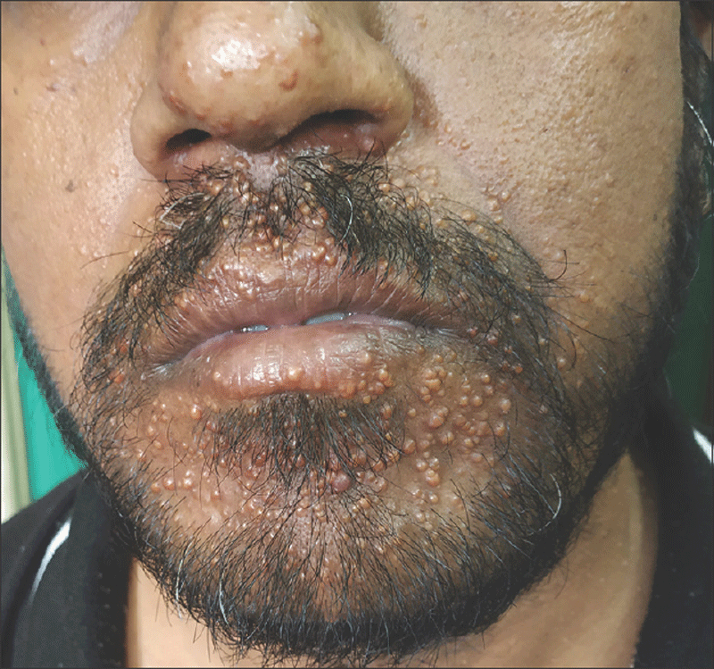 Xanthoma disseminatum