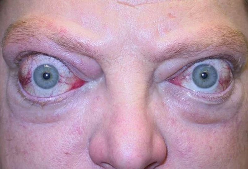 Eye graves disease Definition of Eye graves disease